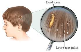 treating lice